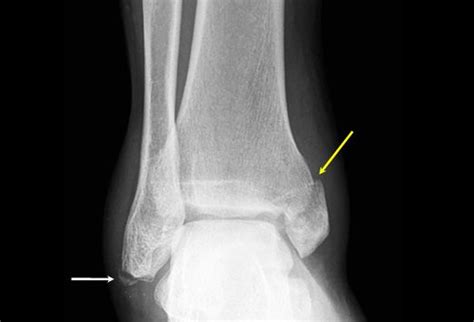 Medscape Log In Avulsion Fracture Foot Health Care Radiology