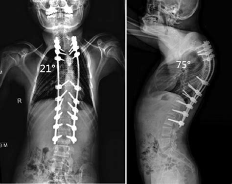 At The Final Follow Up Long Standing Scoliosis Radiographs Revealed