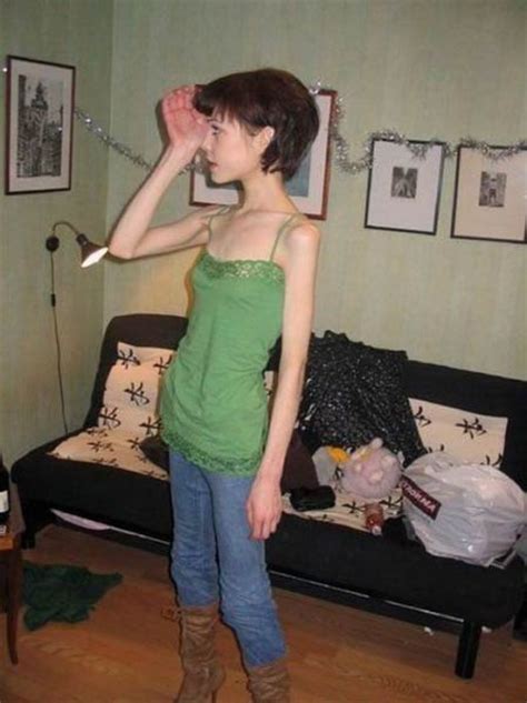 [18sx] anorexic girls 17 pics peristiwa dunia mitos and sejarah peristiwa forum cari