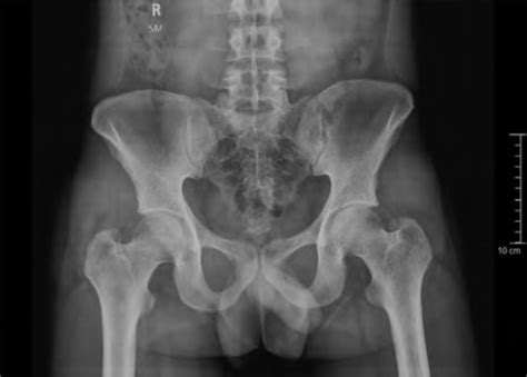 X Ray Pelvis With Both Hip Joints Anteroposterior View