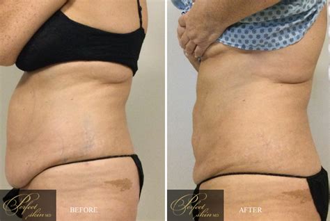 Tumescent Liposuction In Juno Beach Fl Fat Reducing Treatments