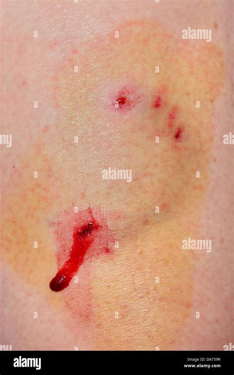Disinfect Wound Hi Res Stock Photography And Images Alamy