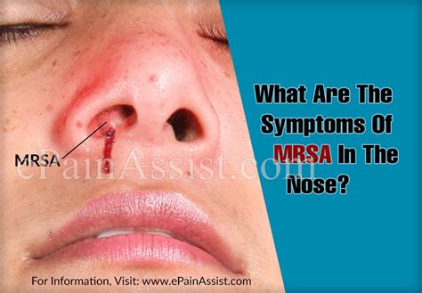 Check spelling or type a new query. What Are The Symptoms Of MRSA In The Nose?