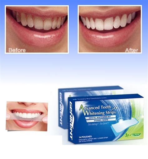 Impressive Bright White Smile Teeth Whitening Kit Advanced Whitening