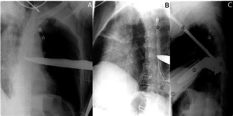 Chest Radiographs Of The Patient In The Right Decubitus Position A