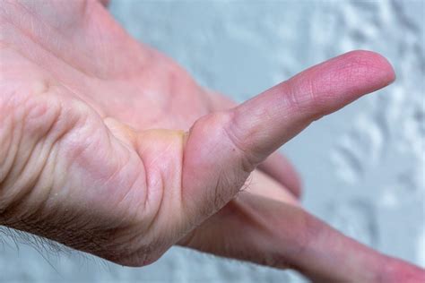 Causes Of Dupuytrens Contracture Archives Arora Hand Surgery