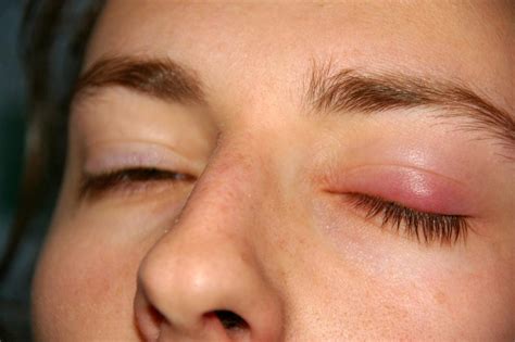 Chalazion Symptoms Causes And Treatments Fraser Valley Cataract