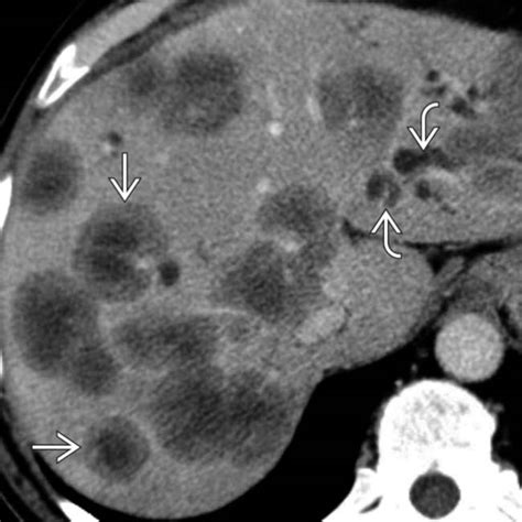 Hepatic Metastases And Lymphoma Clinical Gate
