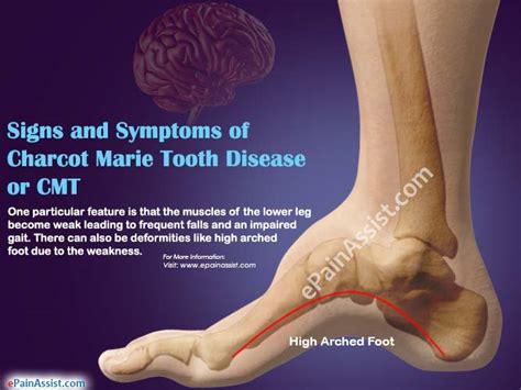 Charcot Marie Tooth Disease Or Cmt Symptoms Causes Types Treatment