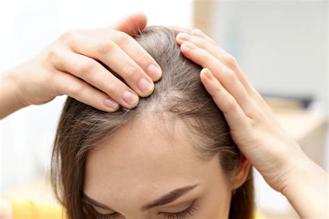 queda de cabelo saiba o que causa e como tratar com 10 dicas