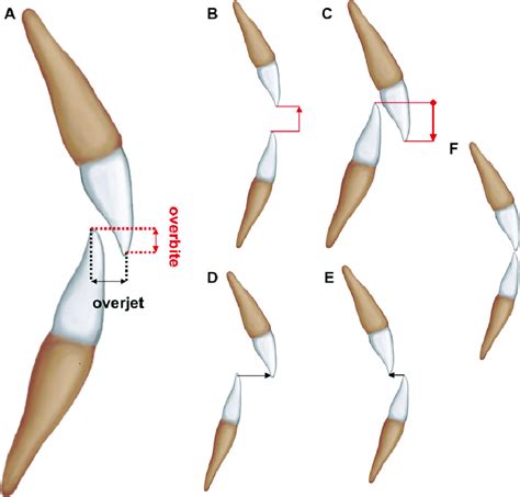 Illustration Of Upper And Lower Incisor Relationships A Ideal