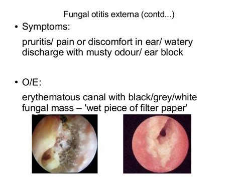 Otitis Externa Bacterial Vs Fungal Images Result Samdexo