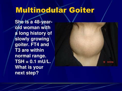 Ppt Simple Nontoxic Goiter Diffuse And Multinodular Powerpoint