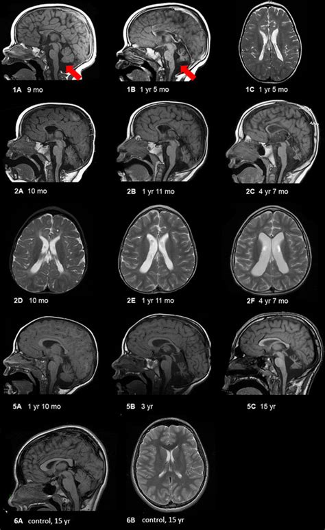 Mri Findings In Selected Patients Showing Progressive Cerebellar And