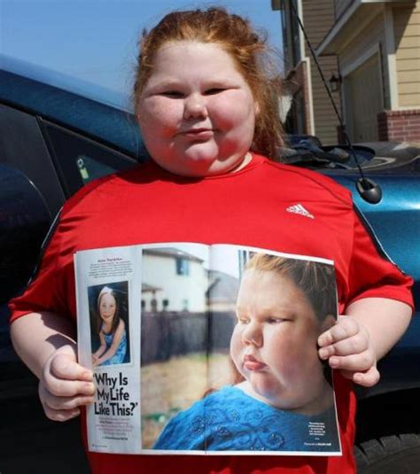 Obese 12 Year Old Girl Who Can T Stop Eating Gets Lifesaving Surgery