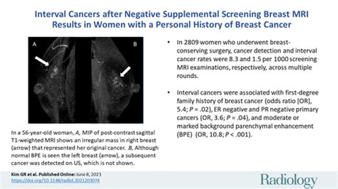 Interval Cancers After Negative Supplemental Screening Breast Mri