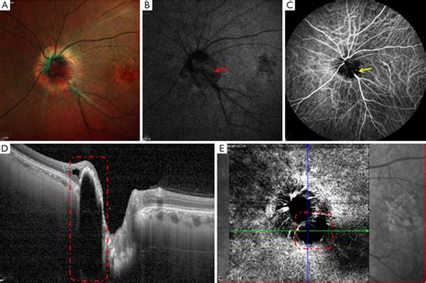 Multimodal Imaging Of An Odm In The Left Eye A Multicolor Imaging