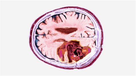 Glioblastoma Is It A High Or Low Grade Tumor And How Do Doctors Decide