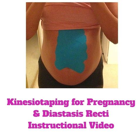 Diastasis Recti Kinesiotaping Fit Mama Santa Barbara Post Pregnancy