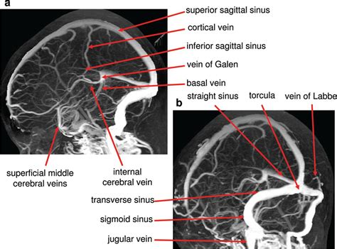 Normal Vascular Imaging Practical Neurology