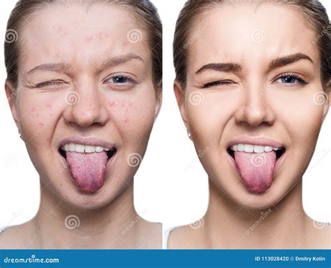 Woman With Acne Before And After Treatment And Make Up Stock Photo