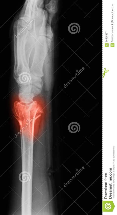 X Ray Image Of Wrist Joint Lateral View Stock Image