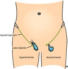 In order to diagnose the underlying cause of a lump in the groin, a physician will perform a physical exam and ask about the patient's medical history and symptoms. Inguinal Ligament Pain - CoreWalking