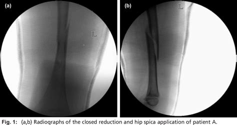 Figure 1 From Can Paediatric Femoral Fracture Hip Spica Application Be Done In The Outpatient