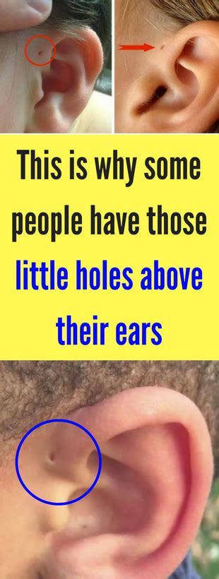 This Is Why Some People Have Those Little Holes Above Their Ears