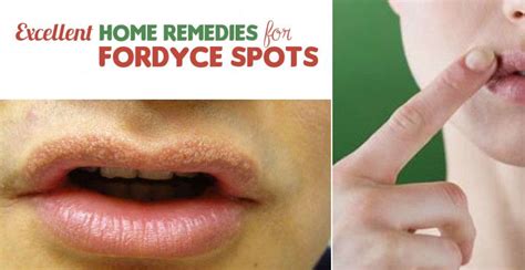 Check Out The Home Remedies For Fordyce Spots That Will Help You Get