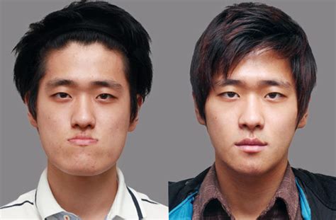 South Korean Plastic Surgery Before And After