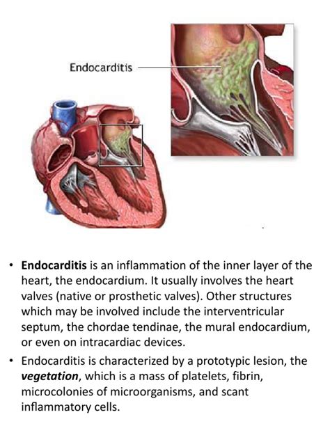 Endocarditis Medical Specialties Diseases And Disorders