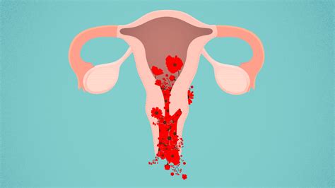 hemorragia uterina anormal enarm youtube sexiz pix