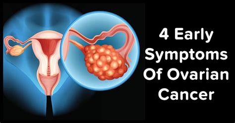 4 Must Know Early Detection Symptoms Of Ovarian Cancer