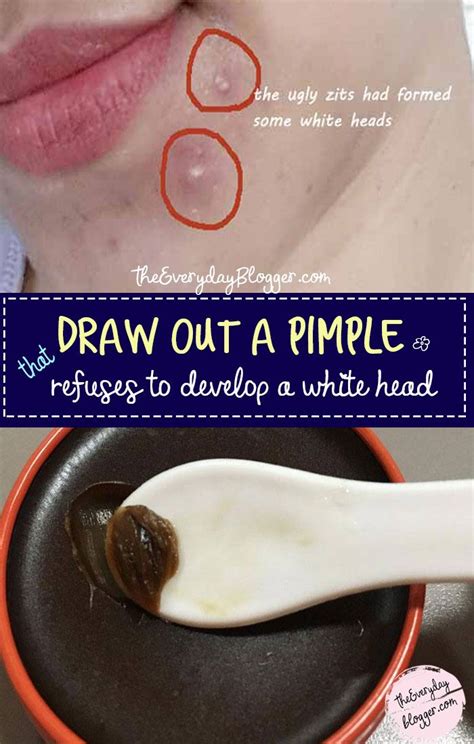 Draw Out A Pimple Zit Remedy Pimples Remedies Skin Remedies Health