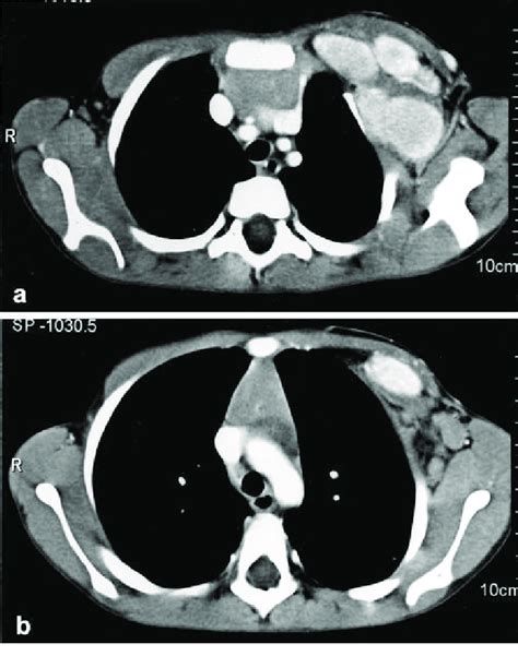 A B Contrast Enhanced Axial Ct A Well Defined Subpectoral Masses