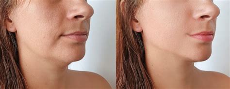 Double Chin Heres How Chin Liposuction Can Fix That