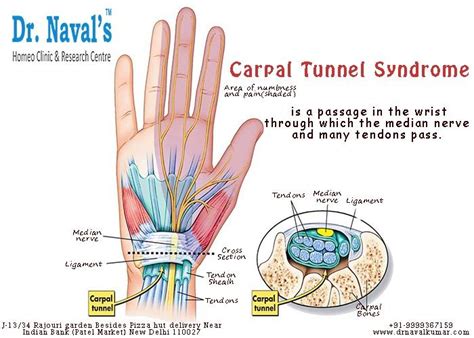 Carpal Tunnel Syndrome Is A Passage In The Wrist Through Which The