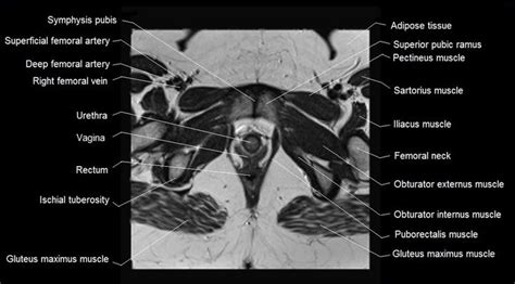 Mri Pelvis Muscle Anatomy Porn Sex Picture