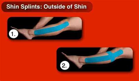 Kinesiology Taping For Shin Splints Shin Splints Kinesiology Taping