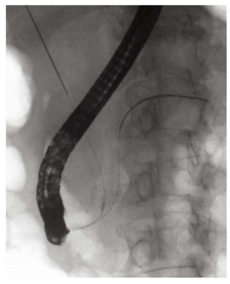 Pancreatic Duct Guidewire Placement For Biliary Cannulation In A Single