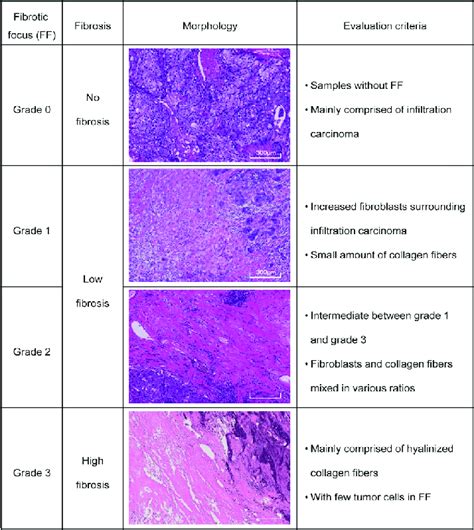 Morphology And Definition Of Different Grades Of Fibrosis In