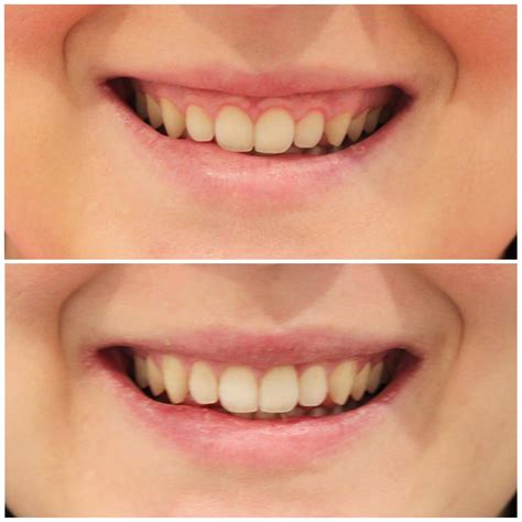 Gum Lifts Brisbane Free Consult Smiling Dental