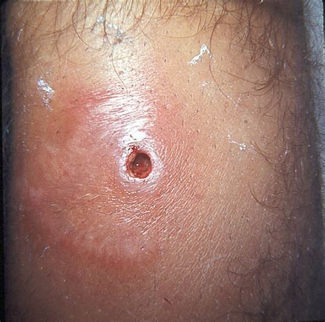 Medical Pictures Info Brown Recluse Spider Bite