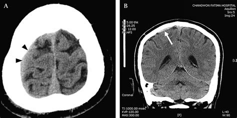 Improved Visualisation Of A Subdural Haematoma With The Use Of