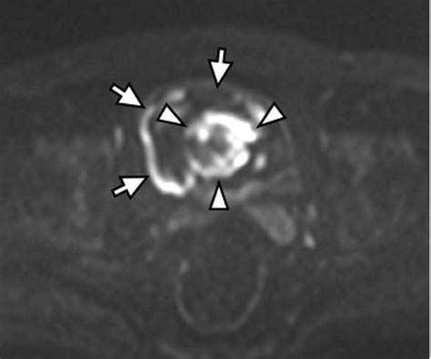 A Mri T2 Weighted Image And B Diffusion Weighted Image Showed A