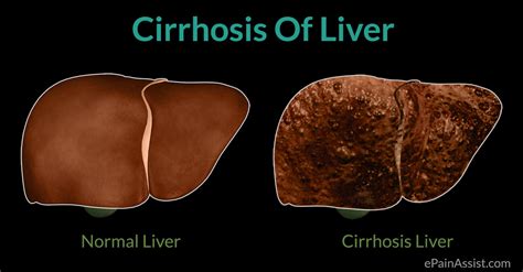 Cirrhosis Of Liver Causes Symptoms Treatment Complications