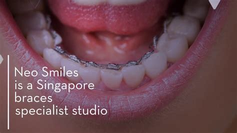 Cheap Braces In Singapore Youtube