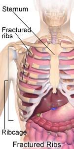  3   4 this rib cage tightness symptom is an example. This is that article.