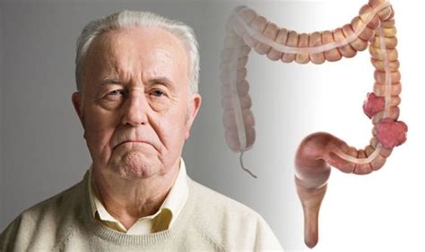 Bowel Cancer Symptoms Feeling Bowel Doesnt Empty Could Signal The